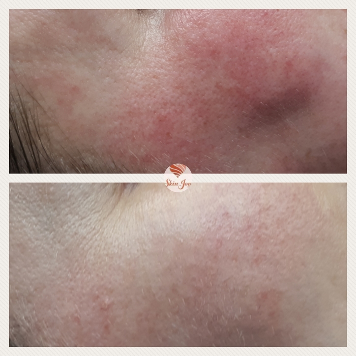 KP Procell for rosacea 1